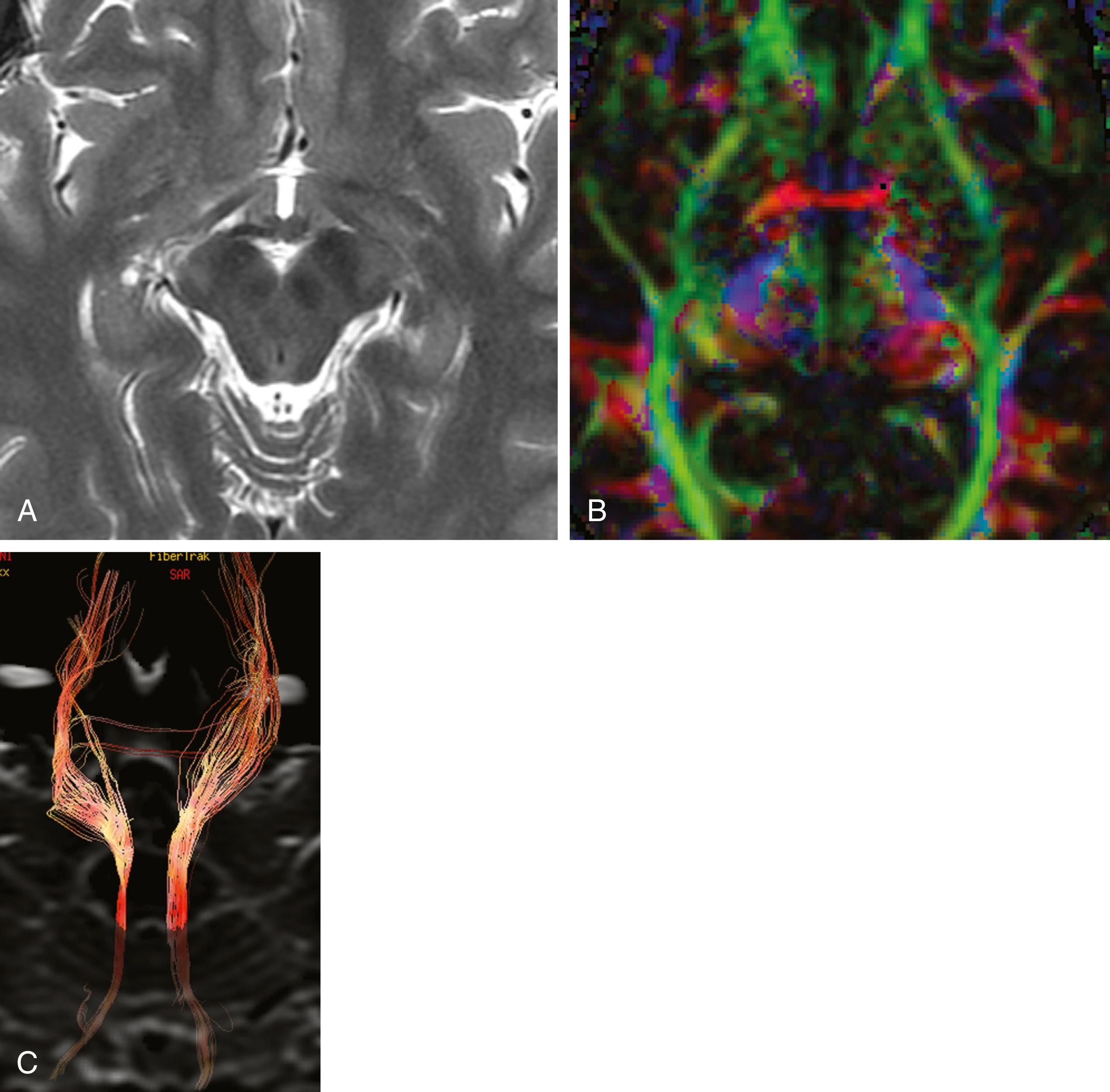 FIGURE 118.2, (A) Axial T2 weighted image of the midbrain at the level of the superior colliculi demonstrating the major nuclei groups. (B) Axial fractional anisotropy image at the level of the midbrain showing the major ascending and descending tracts. Note the circled area, which represents the ascending spinothalamic tracts. (C) Tractography (diffusion tensor imaging, DTI) depicting the ascending spinothalamic tracts bilaterally.