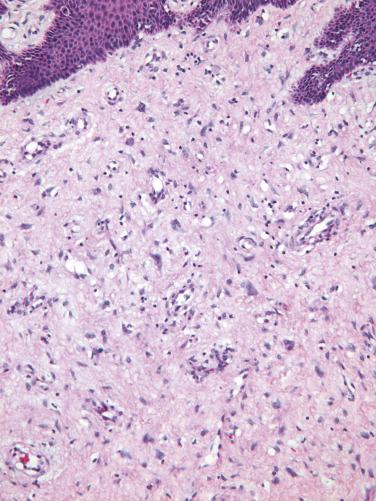 FIG. 4.1, Fibroepithelial stromal polyp. Characteristic stellate and multinucleated stromal cells are prominent near the stromal–epithelial interface.