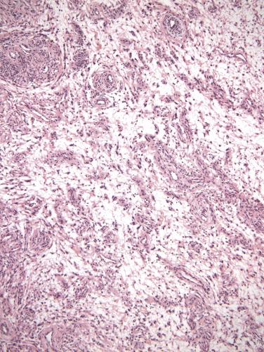 FIG. 4.3, Angiomyofibroblastoma. Alternating hypocellular and hypercellular areas are seen. Tumor cells tend to cluster around numerous capillary-sized vessels.