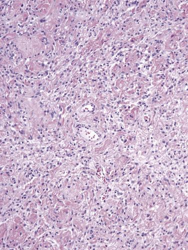 FIG. 4.4, Cellular angiofibroma. Short intersecting fascicles of bland spindle-shaped cells and numerous small- to medium-sized vessels are present in a collagenous background.