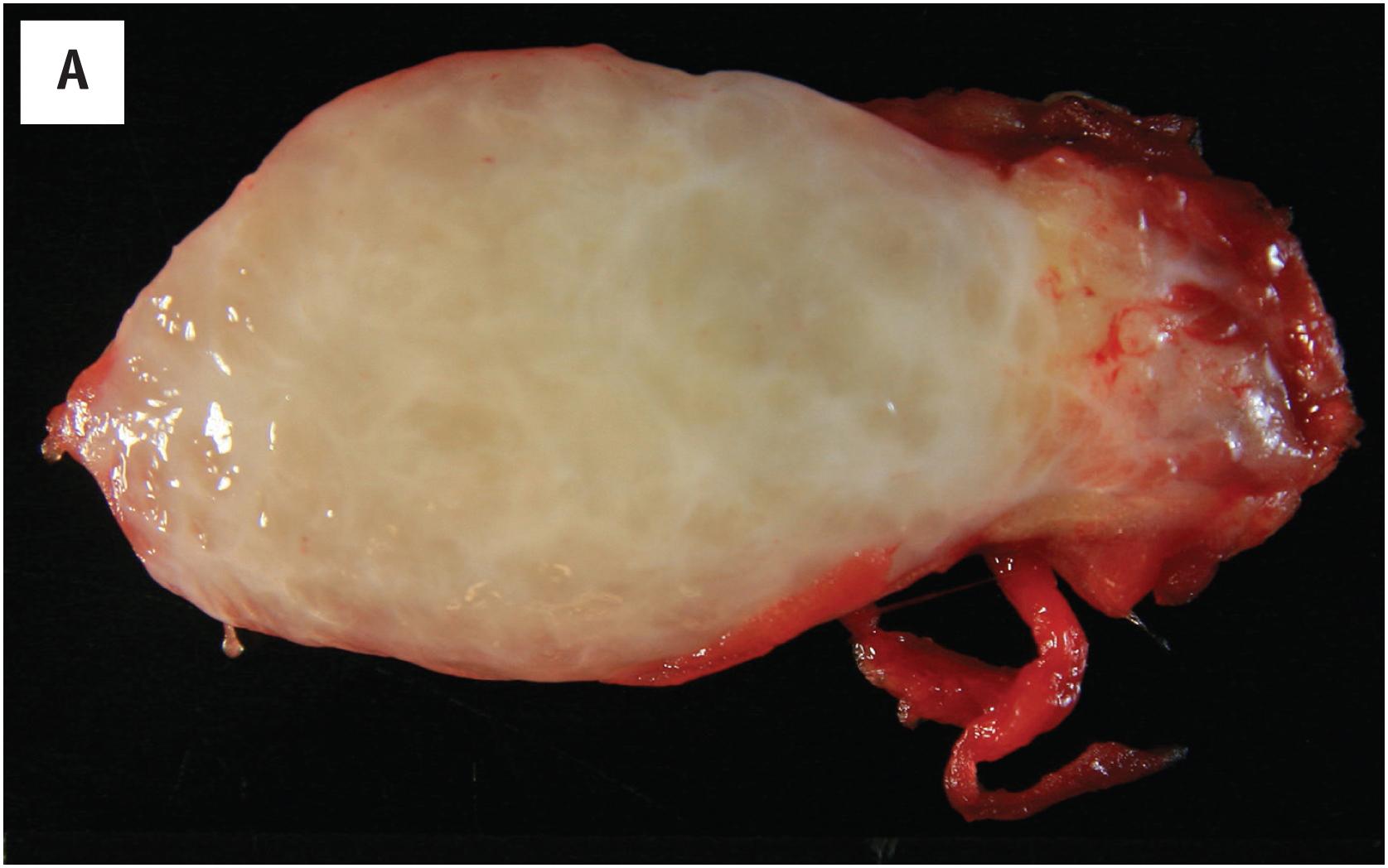 Fig. 15.1, (A) Gross image of intramuscular myxoma. Note uniformly myxoid stroma and extension into the skeletal muscle. (B) Intramuscular myxoma, a uniformly myxoid, hypocellular lesion with characteristic splaying apart of skeletal muscle. (C) Myxoid matrix, relative hypovascularity without arborizing vessels, and microcystic change in intramuscular myxoma. (D) The cells of intramuscular myxoma are bland, with scant eosinophilic cytoplasm and pyknotic nuclei.