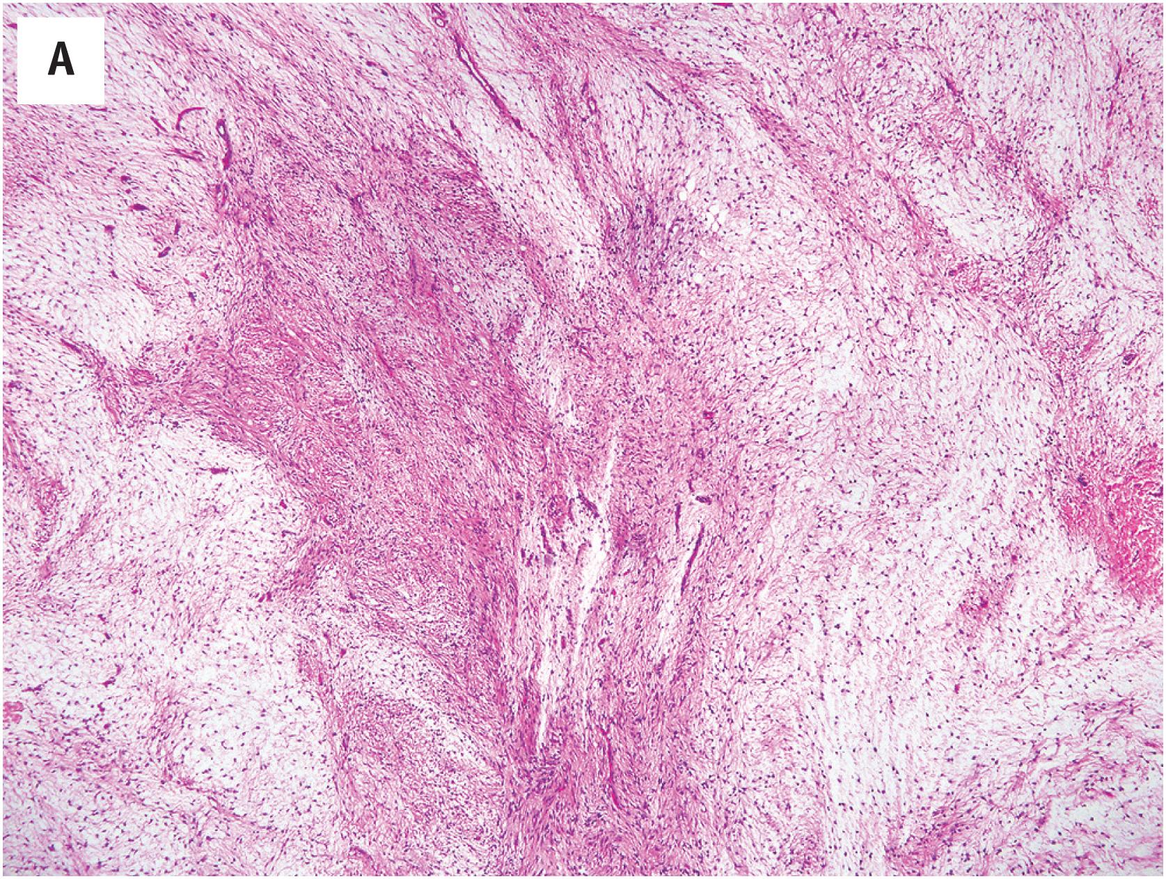 Fig. 15.2, (A) Juxta-articular myxomas are frequently more cellular and vascular than are other myxomas, and may mimic various myxoid sarcomas. (B) Fascicular, cellular growth in juxta-articular myxoma. (C) Careful inspection of juxta-articular myxomas, and other cellular myxomas, will invariably reveal small areas of more typical myxoma, with cystic change.