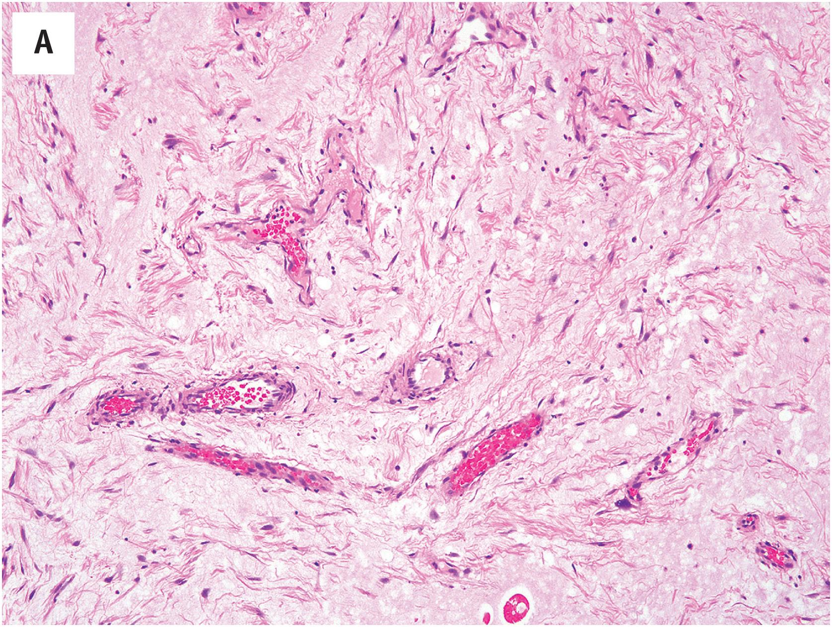 Fig. 15.3, (A) Cutaneous myxoma (angiomyxoma), a highly vascularized myxoid tumor of the skin and subcutis. (B) The cells of cutaneous myxoma are uniformly normochromatic, assisting in its distinction from superficially located myxofibrosarcomas. Note also the presence of stromal neutrophils, a useful clue. (C) The loss of PRKAR1A expression is observed in most superficial angiomyxomas, whether Carney Complex-associated or not.