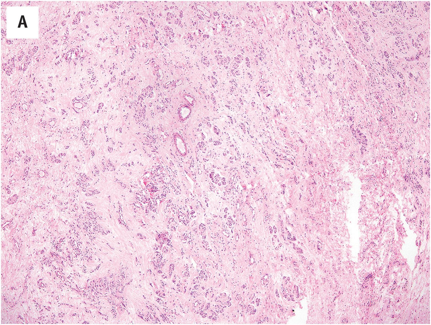 Fig. 15.4, (A) Angiomyofibroblastoma, showing abundant myxohyaline stroma and clusters of epithelioid genital-type myofibroblasts surrounding blood vessels. (B) Clusters of bland epithelioid cells arrayed about a small blood vessel in angiomyofibroblastoma.