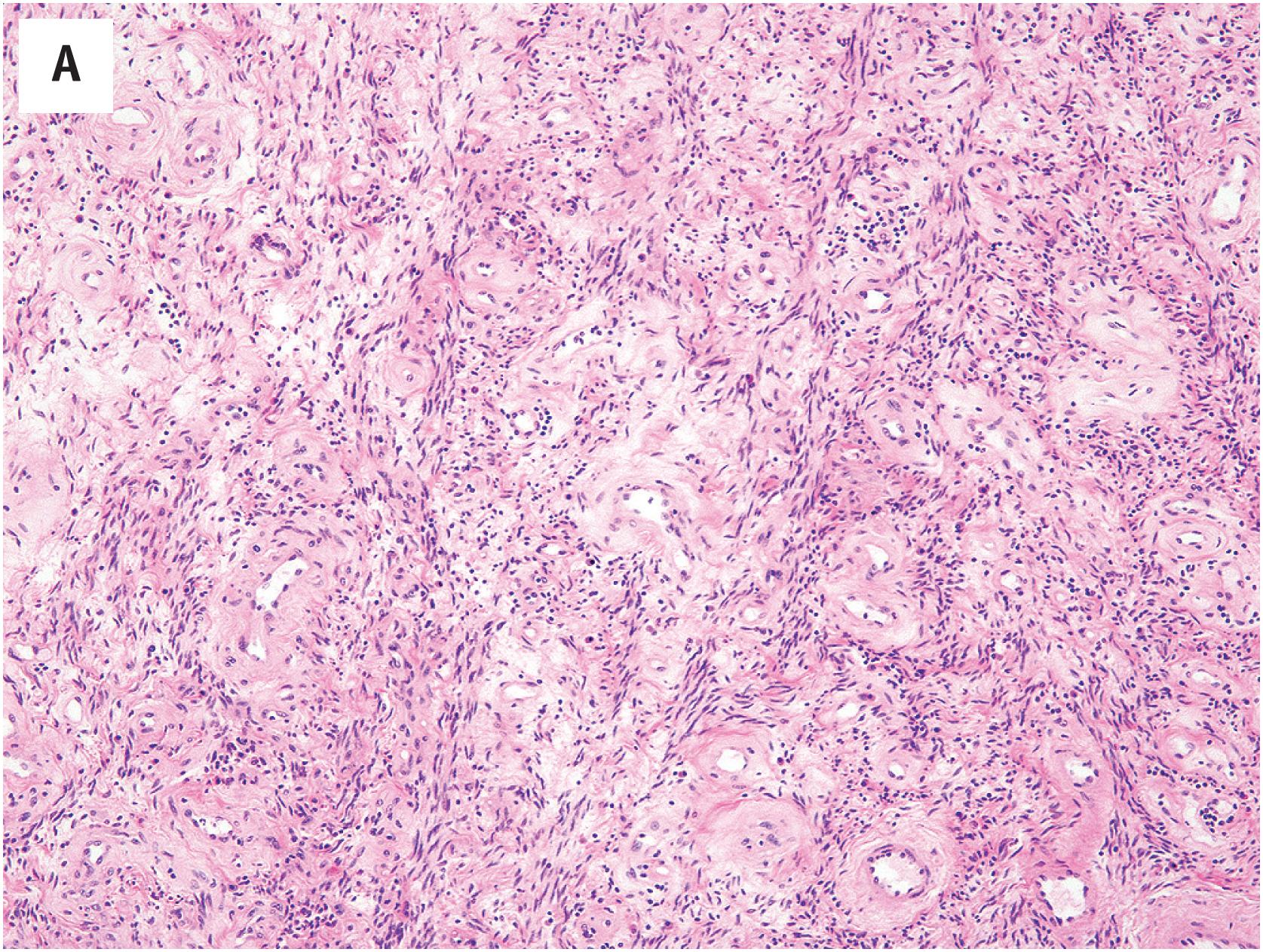 Fig. 15.5, (A) Cellular angiofibroma is closely mammary-type myofibroblastoma and spindle cell lipoma. Classically, cellular angiofibroma displays bland spindled cells arrayed about thicker, hyalinized blood vessels. (B) Bland spindled cells, wiry collagen, and hyalinized blood vessels in cellular angiofibroma. (C) Pseudomalignant nuclear changes may be seen in some cellular angiofibromas. (D) Myxoid cellular angiofibroma, occurring in the scrotum of an older male. (E) Desmin expression in scrotal angiofibroma.(F) The loss of RB1 protein expression characterizes this family of tumors. (G) Mammary-type myofibroblastoma occurring in the inguinal region of a male, with identical morphology to myofibroblastoma of the breast.