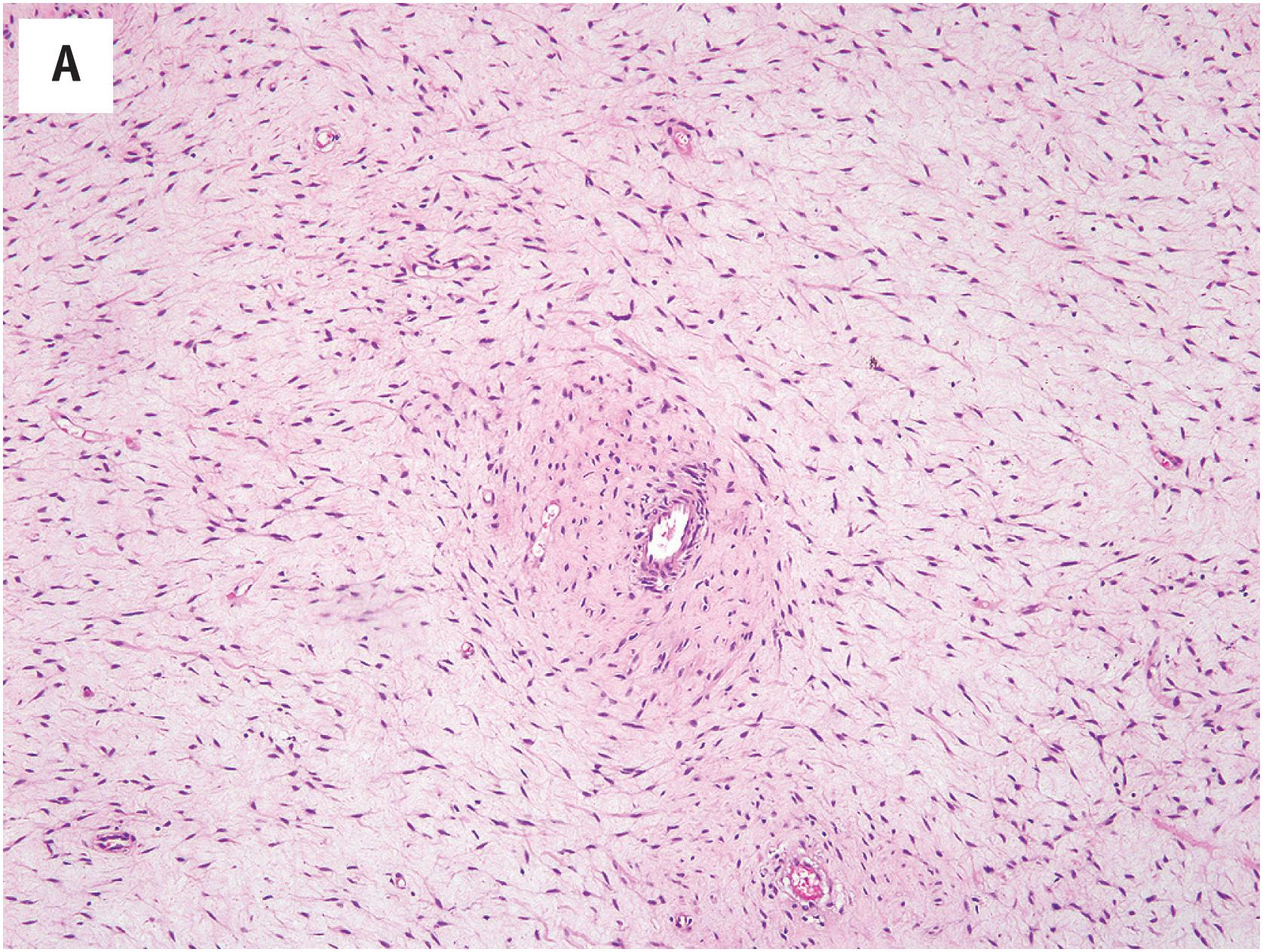 Fig. 15.6, (A) Deep angiomyxoma, a deeply situated, uniformly myxoid tumor, with low cellularity and numerous thin-walled, nonarborizing vessels. (B) Spindled to stellate tumor cells in deep angiomyxoma. (C) Small wisps of smooth muscle are often observed emanating from the vessels in deep angiomyxoma. (D) HMGA2 expression in deep angiomyxoma.