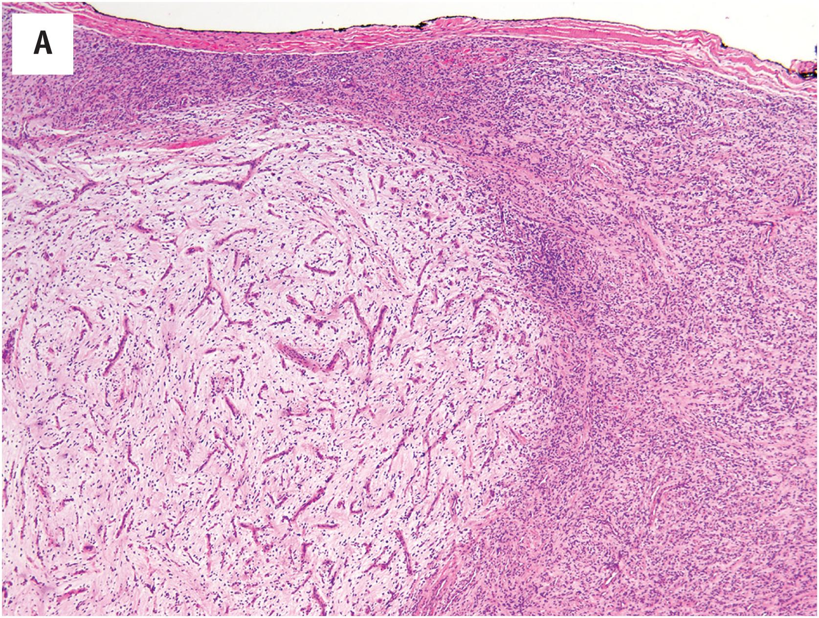 Fig. 15.7, (A) Angiofibroma of soft tissue, exhibiting a characteristic admixture of collagenized areas with a branching vasculature, juxtaposed to myxoid nodules with an elaborate capillary vasculature. (B) Higher-power view of “myxoid liposarcoma-like” capillaries in soft tissue angiofibroma.