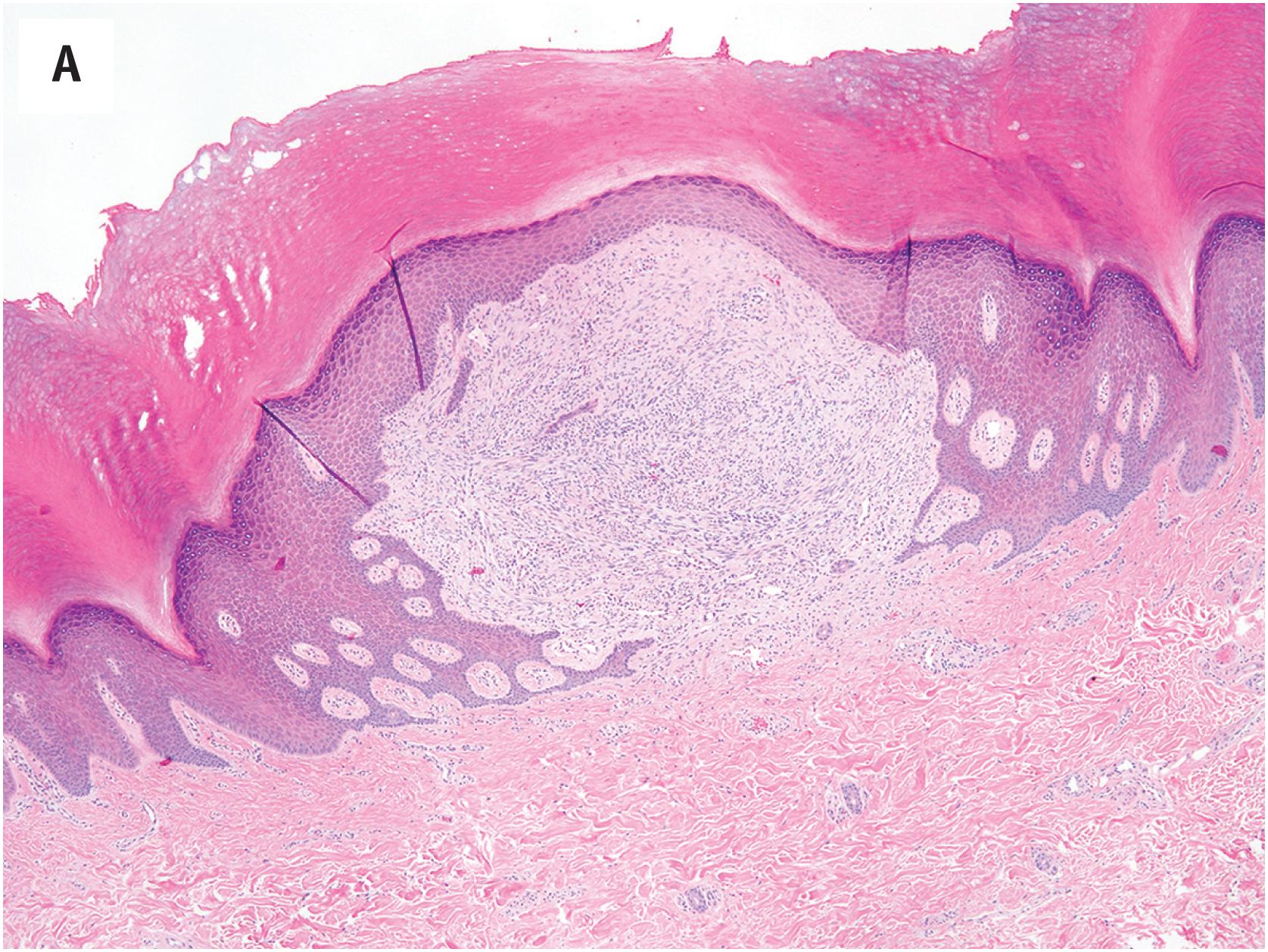 Fig. 15.8, (A) EWSR1-SMAD3-rearranged fibroblastic tumor, presenting as a small nodule on the foot of a young woman. (B) The unusual tumors typically involve the dermis and subcutis, and consist of interlocking fascicles of bland fibroblastic spindled cells. (C) Higher-power view of fibroblastic fascicles in EWSR1SMAD3 tumor. (D) These tumors grow in an infiltrative fashion but are cytologically very bland. € For unknown reasons, diffuse ERG expression in the absence of the expression of other endothelial markers is typical.