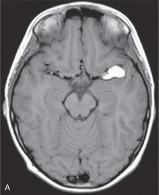 Fig. 14.1, Lipoma. (A) Axial noncontrast T-1 weighted MR image of a lipoma in the right hemisphere with typical hyperintense signal. The hyperintensity was abolished on fat suppression images (not shown). (B) T2-weighted MRI from another case shows an intramedullary lipoma of the cervical spinal cord. (C) Biopsy revealed mature adipose tissue.