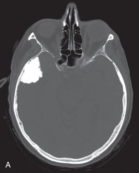 Fig. 14.2, Osteoma. (A) Bone window CT scan showing an osteoma of the temporal bone with exophytic growth intracranially, mimicking an ossified meningioma. (B, C) Histology revealed dense lamellar bone with a focally irregular interface between the lesion and adjacent gliotic brain.