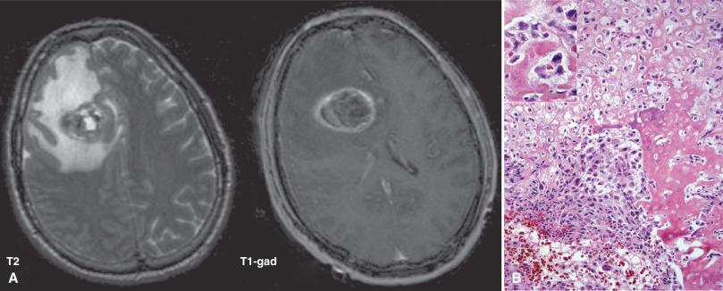 Fig. 14.3, Osteosarcoma. (A) Axial T2- (left) and contrast-enhanced T1- (right) weighted MR image of an osteosarcoma with no evidence of tumor elsewhere in the body. (B) Medium- and high-power (inset) appearance of a classic osteosarcoma with malignant cytology and osteoid formation.