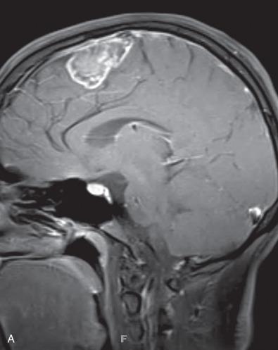 Fig. 14.4, Chondrosarcoma. (A) Sagittal contrast-enhanced T1-weighted MR image of a parasagittal well-differentiated chondrosarcoma. (B) The resection specimen showed a lobulated cartilaginous tumor on gross pathology. (C) Histologic appearance of a classic low-grade chondrosarcoma with well-formed hyaline cartilage, but occasionally enlarged tumor nuclei. (D) Mesenchymal chondrosarcoma composed of “small blue cells” admixed with well-formed hyaline cartilage (right).