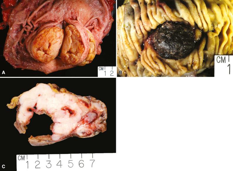 Figure 16.1, Gross Appearances of Gastrointestinal Stromal Tumors.