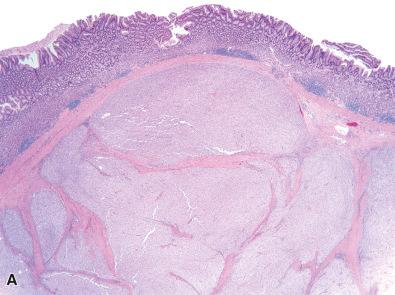 Figure 16.11, Succinate Dehydrogenase-Deficient Gastrointestinal Stromal Tumor.