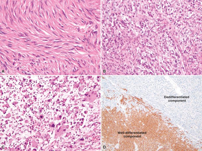 Figure 16.12, Dedifferentiated Gastrointestinal Stromal Tumor.