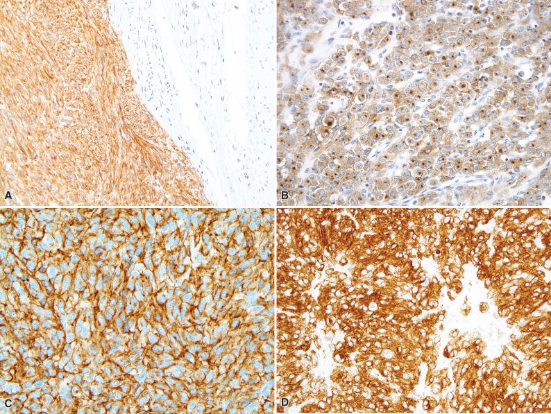 Figure 16.13, Immunohistochemistry for KIT and DOG1 in Gastrointestinal Stromal Tumor.