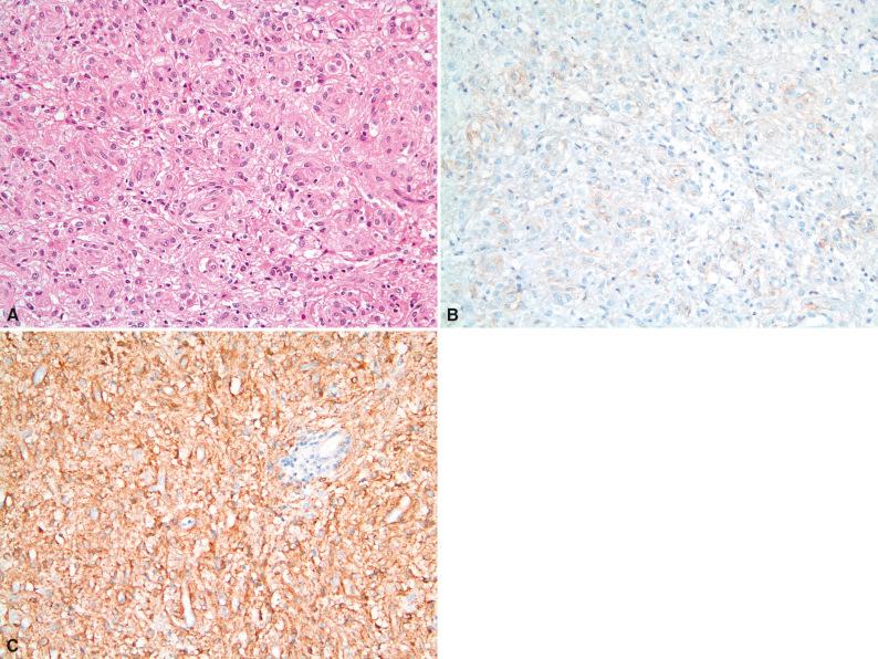 Figure 16.14, PDGFRA -Mutant Gastrointestinal Stromal Tumor.