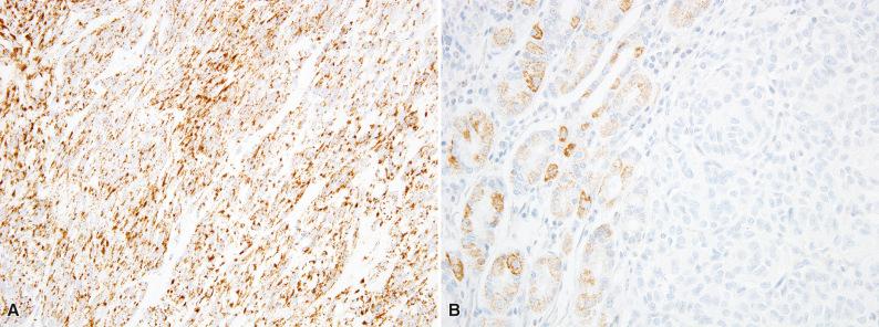 Figure 16.16, Immunohistochemistry for Succinate Dehydrogenase Subunit B in Gastrointestinal Stromal Tumor.