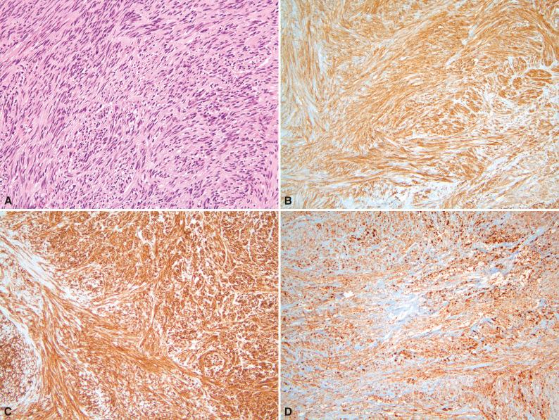 Figure 16.18, BRAF -Mutant Gastrointestinal Stromal Tumor.