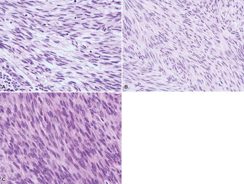 Figure 16.2, Histologic Appearances of Spindle Cell Gastrointestinal Stromal Tumors.