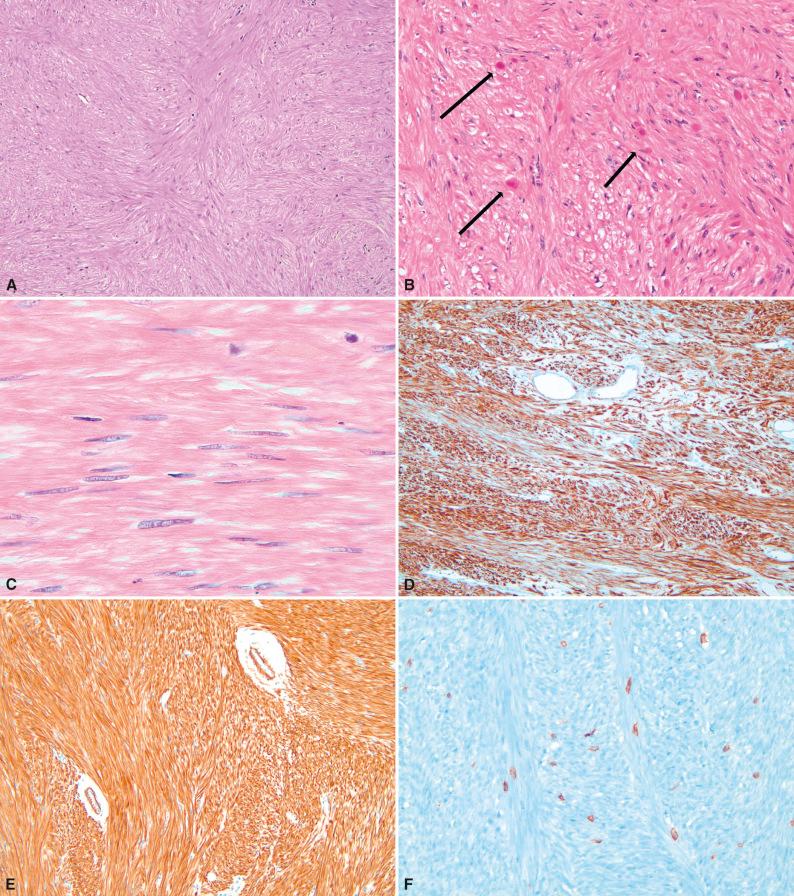 Figure 16.21, Histologic Appearances of Lei omyoma.