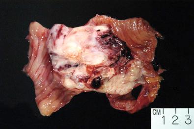 Figure 16.22, Gross Appearance of a Leiomyosarcoma of the Small Bowel.