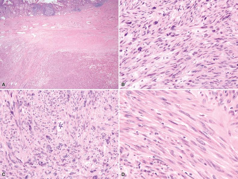 Figure 16.23, Histologic Appearances of Leiomyosarcoma.