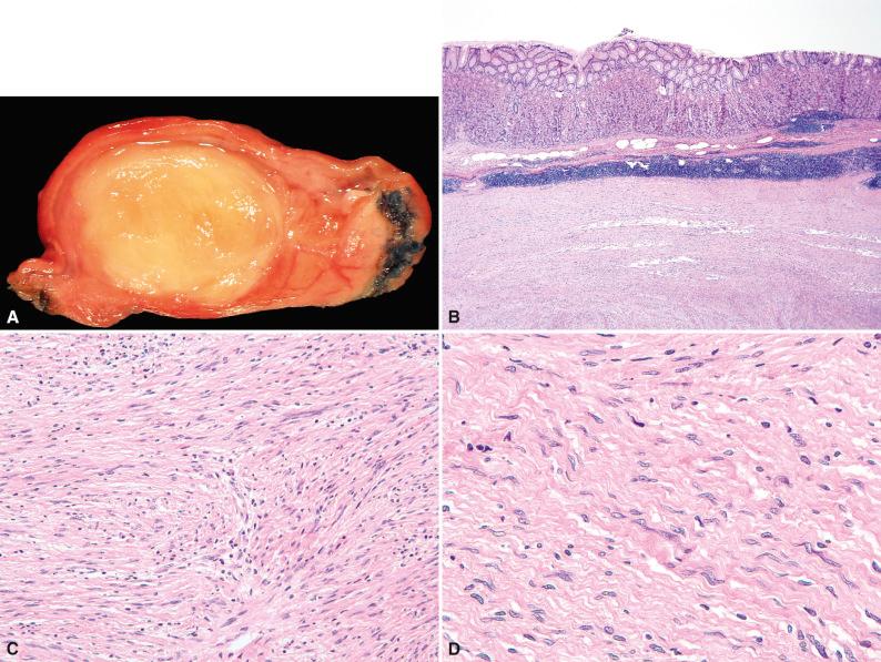 Figure 16.24, Gastric Schwannoma.