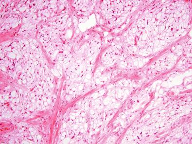 Figure 16.25, Microcystic/Reticular Schwannoma.