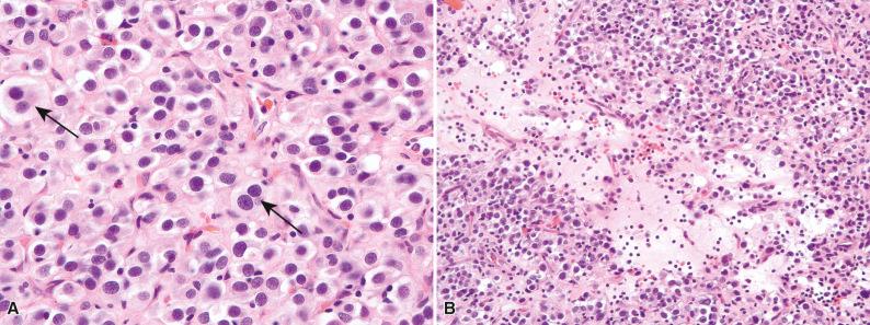 Figure 16.3, Histologic Appearances of Epithelioid Gastrointestinal Stromal Tumors.