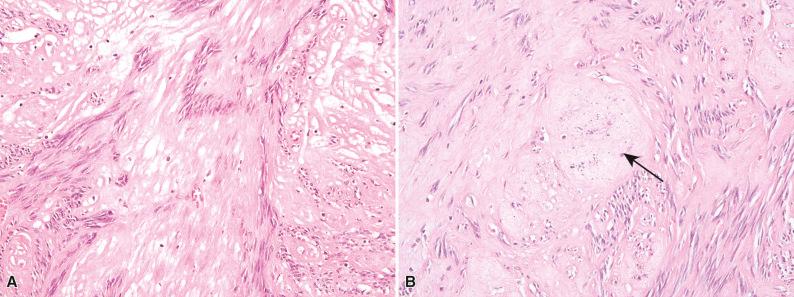 Figure 16.4, Hypocellular Gastrointestinal Stromal Tumor.