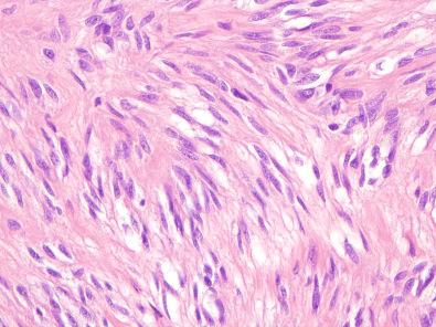 Figure 16.5, Spindle Cell Gastrointestinal Stromal Tumor.