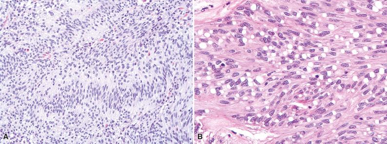 Figure 16.6, Spindle Cell Gastrointestinal Stromal Tumor.