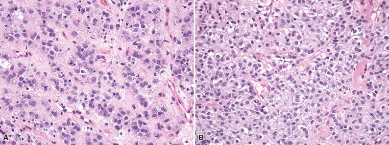 Figure 16.8, Epithelioid Gastrointestinal Stromal Tumor.