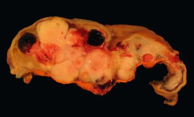 Figure 16.10, Gross Appearance of Succinate Dehydrogenase-Deficient Gastrointestinal Stromal Tumor.