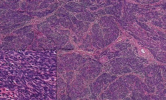 FIG. 11.12, Highly cellular leiomyoma. The tumor displays cellularity akin to an endometrial stromal neoplasm but retains a fascicular arrangement. At high power magnification, the nuclei have a smooth muscle phenotype with elongation and round tapered tips (inset) .