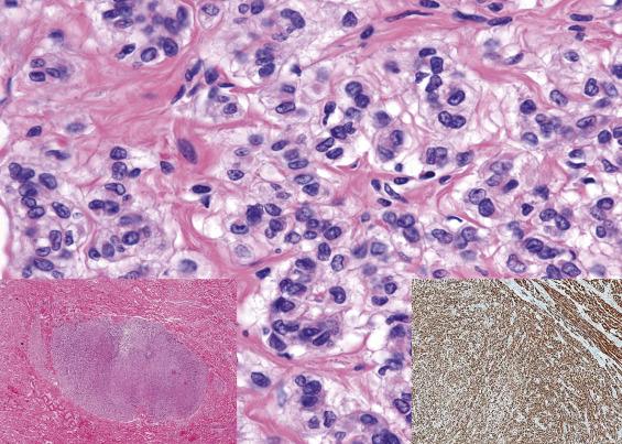 FIG. 11.14, Epithelioid leiomyoma. The tumor is composed of polygonal cells with round, uniform nuclei and pale eosinophilic cytoplasm. There is no necrosis or mitotic activity, and the lesion is well circumscribed (left inset) . Tumor cells are strongly positive for desmin (right inset) .