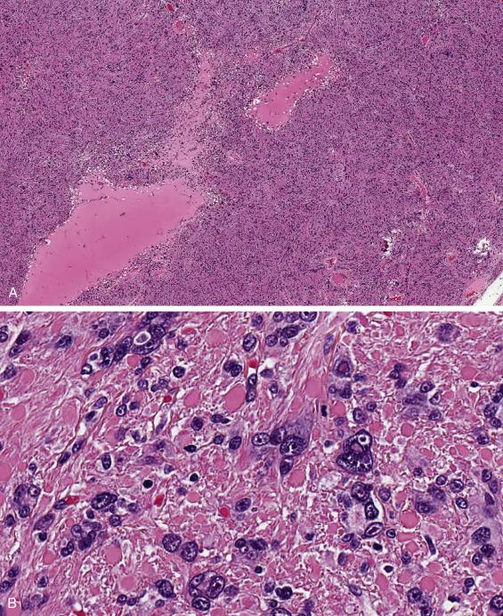 FIG. 11.16, Leiomyoma with bizarre nuclei featuring characteristics associated with hereditary leiomyomatosis and renal cell carcinoma syndrome and FH mutations. This lesion has a diffuse distribution of bizarre cells (A). Cells have distinct globoid eosinophilic inclusions, and nuclei with prominent red nucleoli surrounded by a perinucleolar halo (B).
