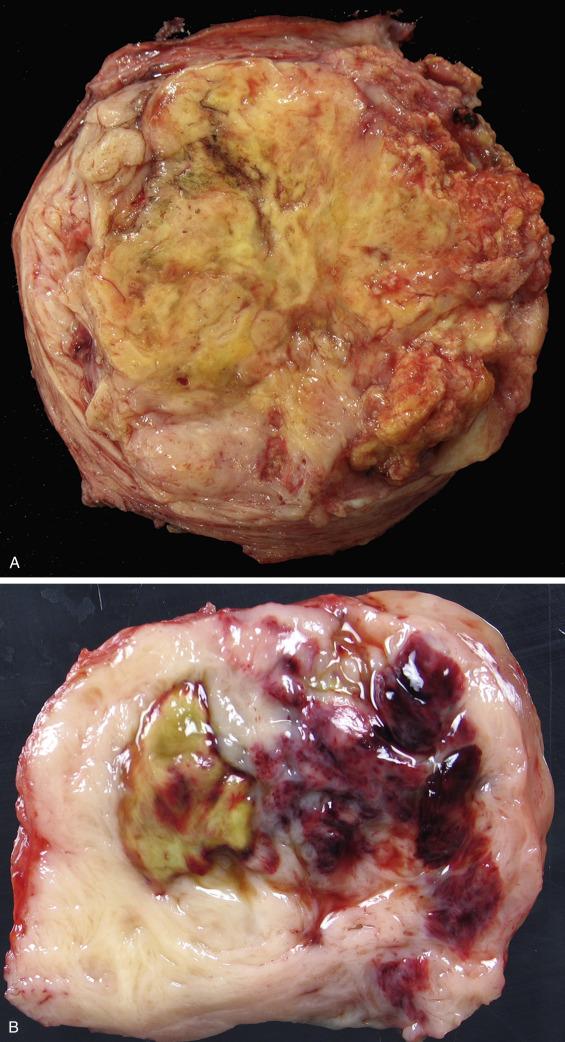 FIG. 11.17, Uterine leiomyosarcoma. The tumor is large and has a heterogeneous cut surface, which often contains areas of yellow discoloration and friable necrotic tissue (A) or extensive hemorrhage (B). Irregular border with extension into vessels can be appreciated on gross examination (C).