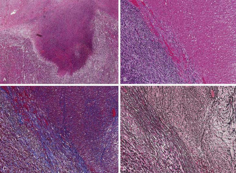 FIG. 11.19, Coagulative tumor cell necrosis in leiomyosarcoma. The sharp demarcation between viable and necrotic areas imparts a “geographic” appearance (A). “Ghosts” of the necrotic cells can be visualized under high power magnification (B). There is no significant collagen deposition, as demonstrated in the trichrome stain (C). Likewise, the pericellular reticulin meshwork is retained in necrotic tumor areas; compare to viable tissue on the lower left aspect (D).