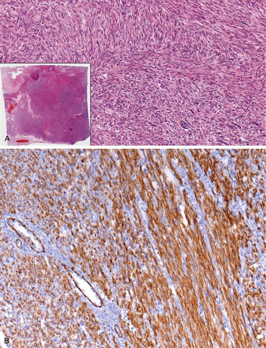 FIG. 11.18, Uterine leiomyosarcoma (conventional). The lesion is usually hypercellular, and the nuclear atypia in the form of nuclear enlargement, irregular nuclear contour and hyperchromasia should be evident at low power magnification (A). The tumor is usually heterogeneous and has areas of necrosis (A, inset ). Tumor cells express smooth muscle markers, of which caldesmon is the most specific (B). CD10 can be diffusely positive (C).