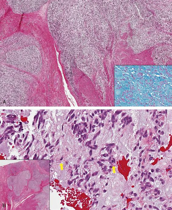 FIG. 11.23, Myxoid leiomyosarcoma. The tumor characterized by irregular, often infiltrative borders (A and inset in B). A. Myxoid stroma must be a dominant feature, comprising at least 50% of the tumor volume; intense blue staining on Alcian blue stain confirms the presence of a myxoid matrix (inset) . B. Atypia and mitoses are usually but not always present. Atypia is seen in the form of hyperchromasia and moderate pleomorphism; two mitoses can be appreciated (arrows) .