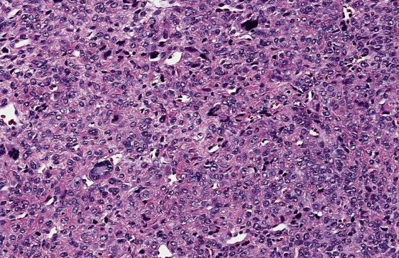 FIG. 11.24, Smooth muscle tumor of uncertain malignant potential in which significant cytologic atypia is present, but mitotic count is only 9 per 10 high-power fields.