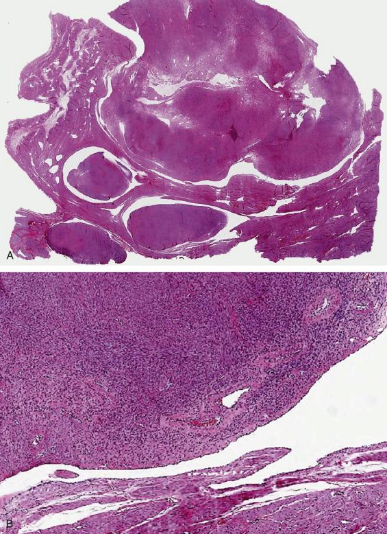 FIG. 11.25, Intravenous leiomyomatosis. Multiple well-defined normocellular to mildly hypercellular tumors occupy markedly distended vessels (A). The outer surface of the leiomyoma, as well as the vessel wall, is covered by endothelium (B).