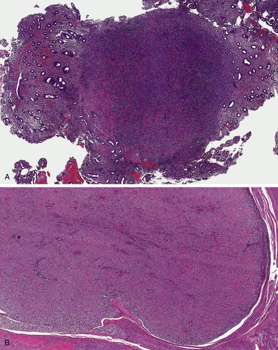 FIG. 11.27, Endometrial stromal nodule. The lesion is defined by its smooth, well-circumscribed borders; in this example, the tumor was confined to the endometrium (A). Minimal infiltration can be noted, less than 3 mm in size (B, lower aspect ). The tumor harbors a uniformly distributed vasculature of small arteriole-sized vessels (C). The tumor cell population is monotonous and only mildly atypical, comprised of short spindled to ovoid cells with scant cytoplasm (C, D). Sex cord differentiation with a nested and trabecular pattern can be seen (D, left aspect ).