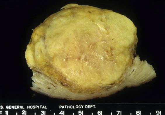 FIG. 11.5, Lipoleiomyoma. When prominent, adipose tissue elements can be seen grossly as areas of soft, bright yellow tissue (in this case toward periphery).