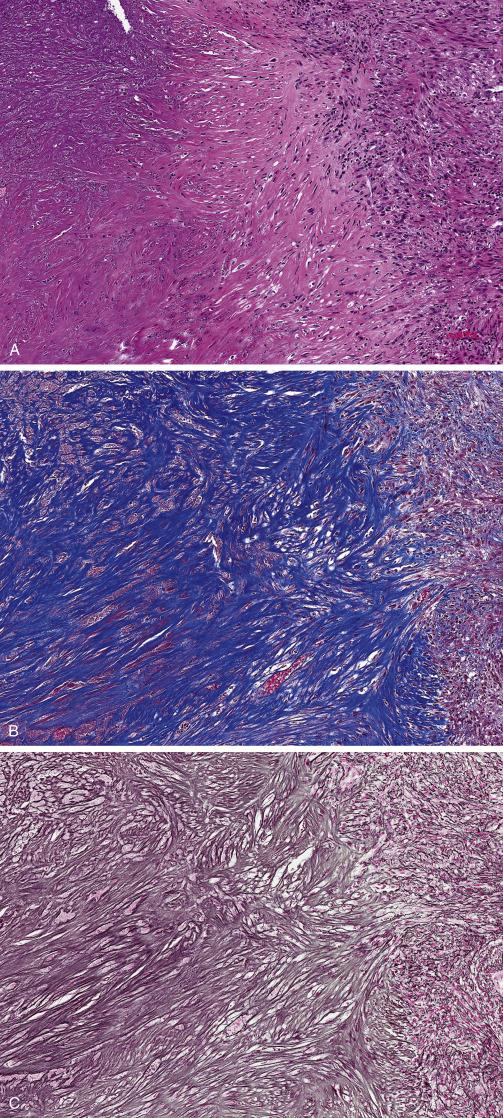 FIG. 11.8, Leiomyoma with ischemic-type necrosis. Transition from viable to non-viable over a broad zone (A). Trichrome stain shows accumulation of collagen, stained in blue (B). Reticulin stain shows loss of pericellular reticulin meshwork due to cell death and replacement by collagen (C).