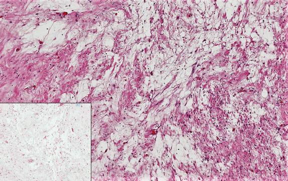 FIG. 11.9, Leiomyoma with hydropic change. Abundant translucent extracellular fluid dissects muscle fibers which may mimic myxoid stroma. However, Alcian blue stain does not demonstrate the bright blue staining indicating a myxoid matrix (inset) .