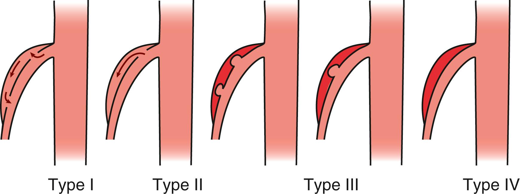 Figure 135.1, Spontaneous isolated superior mesenteric artery dissection classification system proposed by Sakamoto et al.: Type I, patent false lumen with both entry and reentry; Type II, a “cul de sac”–shaped false lumen without reentry; Type III, thrombosed false lumen with ulcer defect; and Type IV, a completely thrombosed false lumen without ulcer.