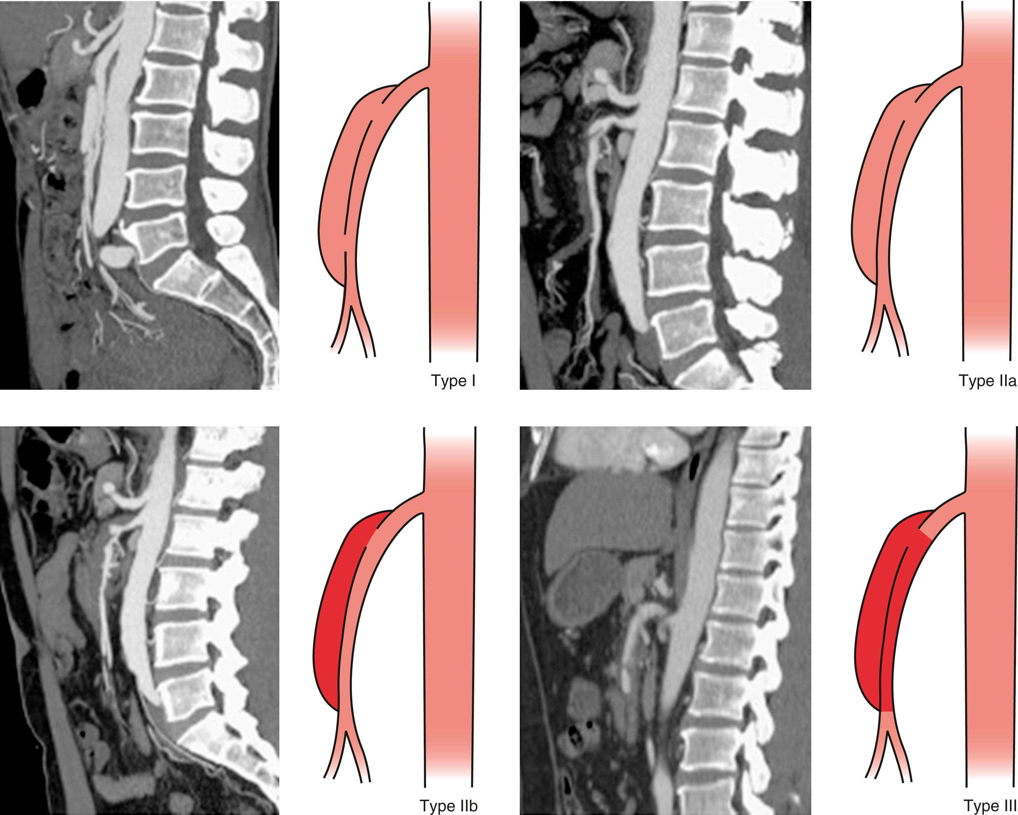 Figure 135.2, Yun et al. classification system for spontaneous isolated superior mesenteric artery dissection: Type I, patent true and false lumen revealing entry and reentry sites; Type IIa, patent true lumen but no reentry of the patent false lumen; Type IIb, patent true lumen but no reentry of thrombosed false lumen; and Type III, dissection with occlusion of superior mesenteric artery.